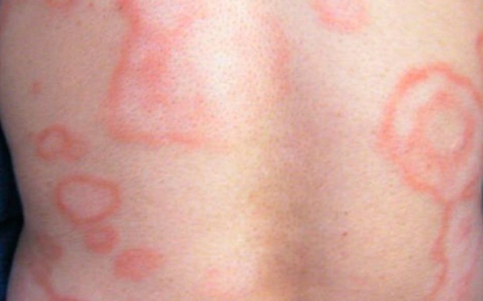 Lepra-Permanencias-Voluntarias