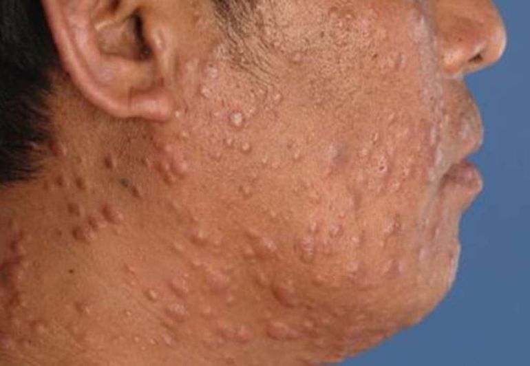 Lepra-Permanencias-Voluntarias